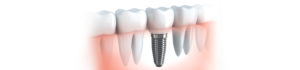 Dr Michael Burgess Maxillofacial Surgeon Brisbane Oral Wisdom Teeth
