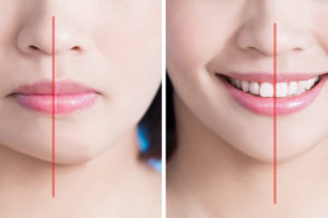 Othognathic & Sleep Apnoea surgery Brisbane