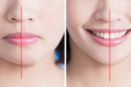 Othognathic & Sleep Apnoea surgery Brisbane