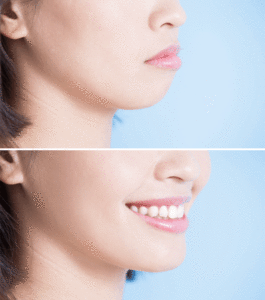 Genioplasty chin procedure surgery brisbane