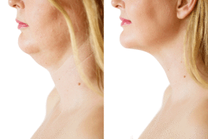 Submental Lipectomy chin procedure brisbane